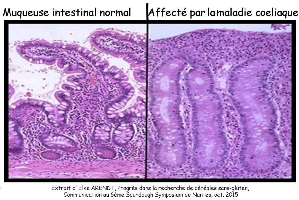 Muqueuse intestinale atteinte.jpg